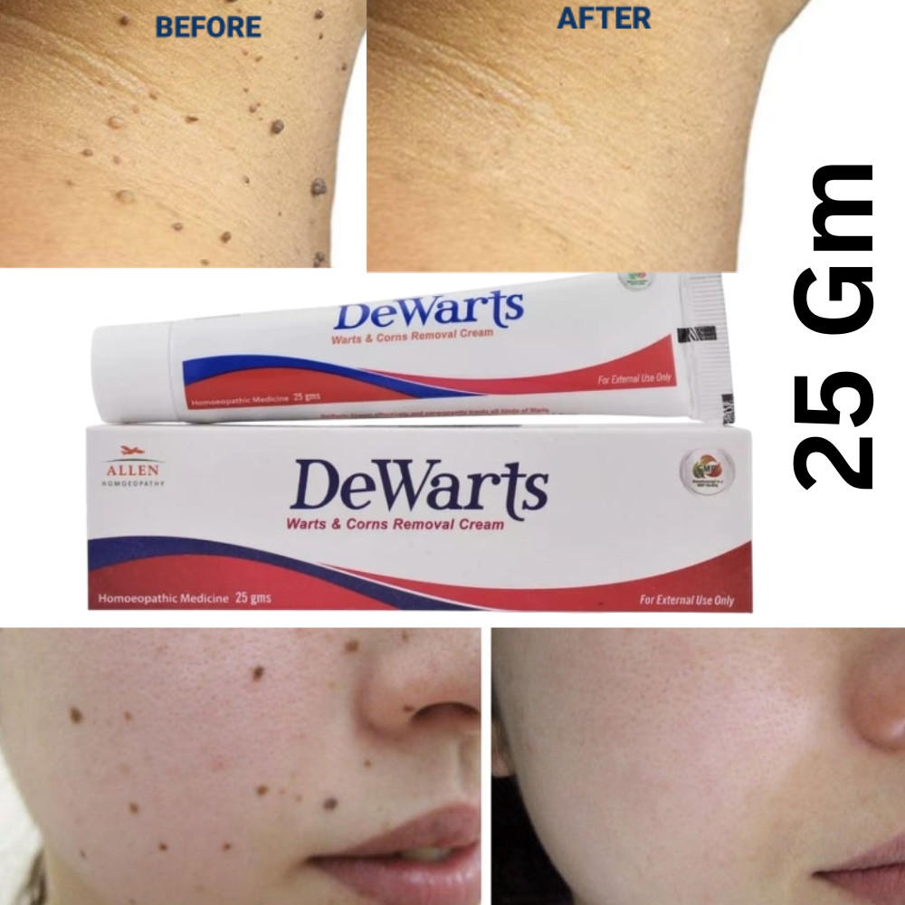 Allen Homeopathic Dewarts Cream for smooth skin effective in warts & corn 25 gm