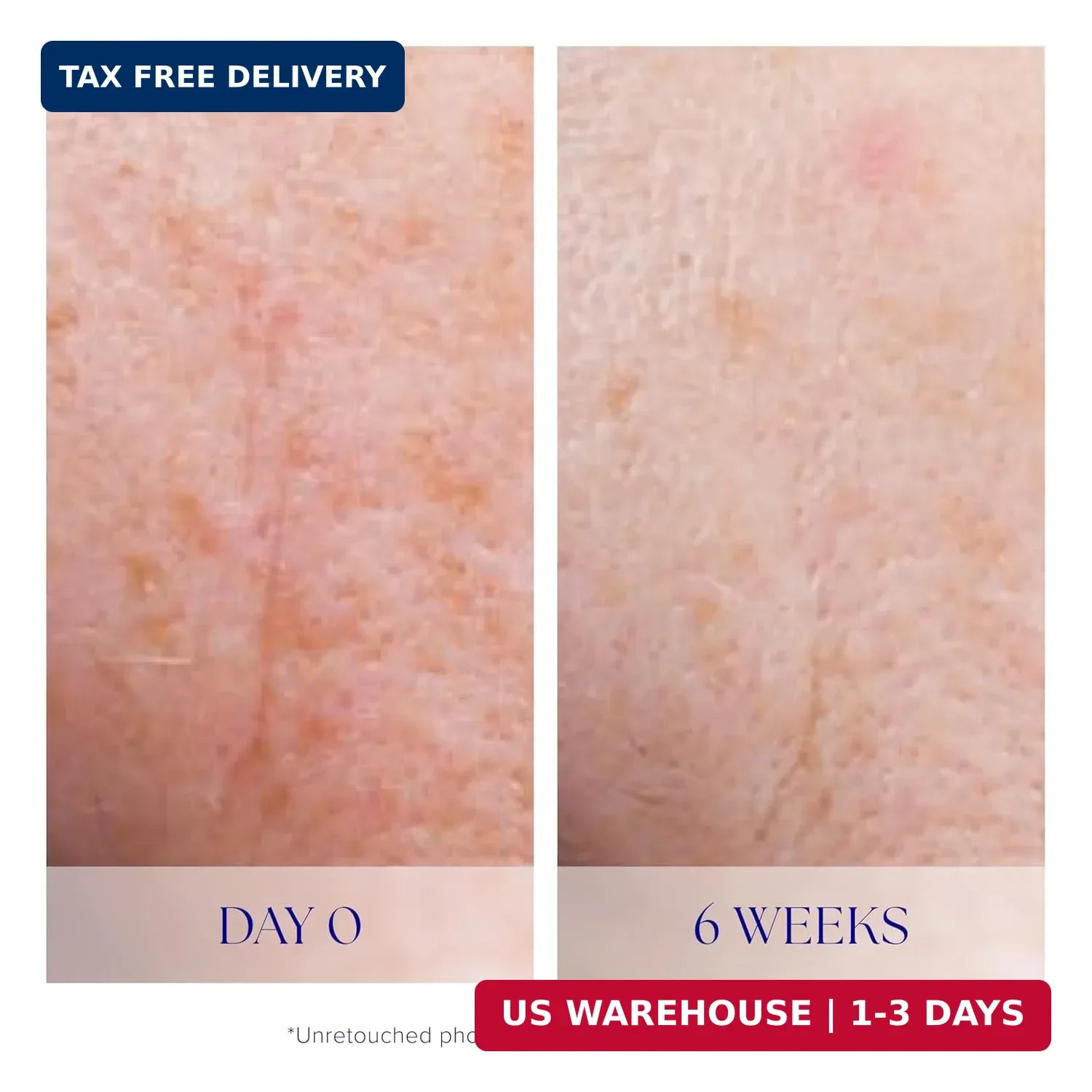 iS CLINICAL Active Serum – Helps visibly even skin tone, Excellent for acne-pron