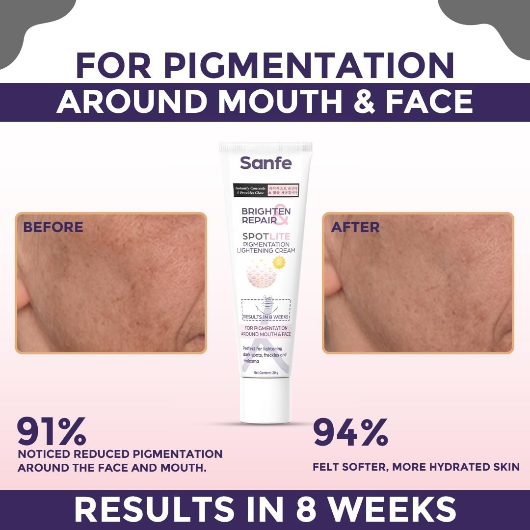 Sanfe Dark Spot Remover For Face Dark Spot Corrector Glow Cream (20gm) With FS