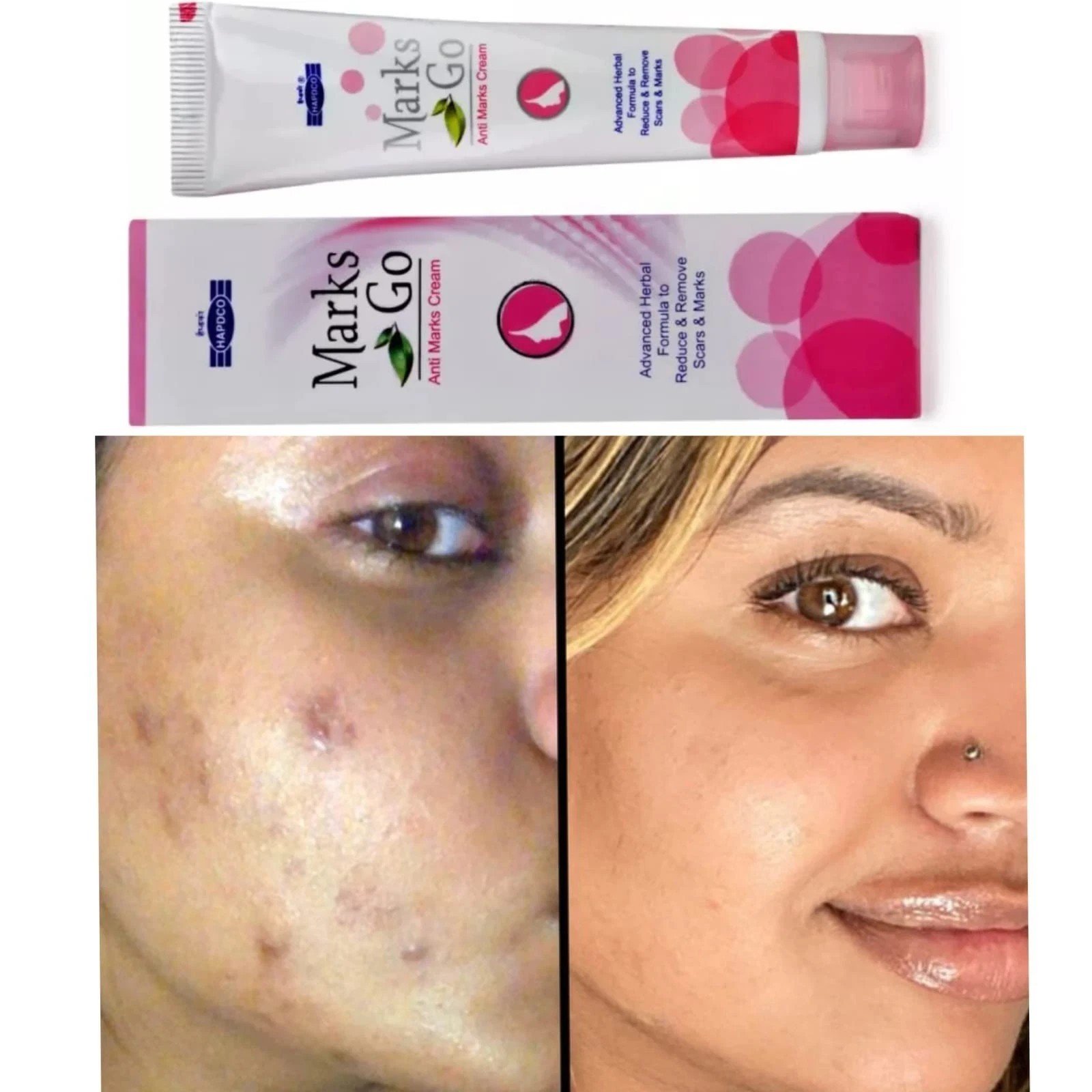 Hapdco Marks Go Cream 25g Help to remove blemishes, dark circles, and burn marks