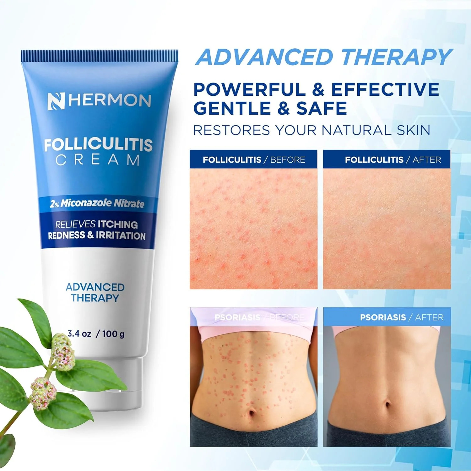 Hermon Folliculitis Cream: Effective for Folliculitis Scalp Face and Body 100g
