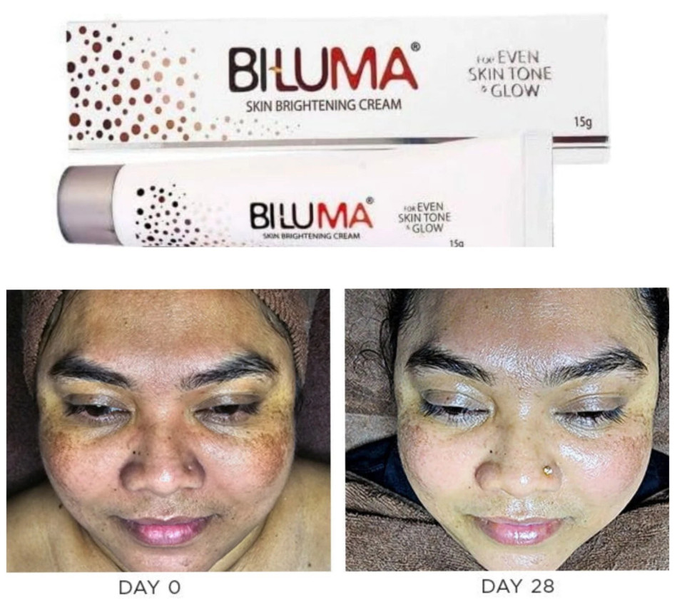 Biluma Skin Brightening Cream | For Even Skin Tone & Glow 15gm