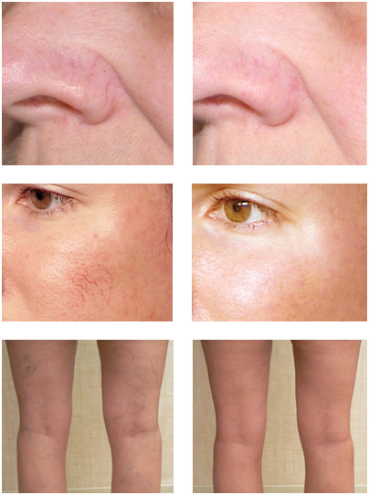 LUX VITAMIN K CREAM Eliminate Spider Varicose Veins Scars Rosacea Capillaries