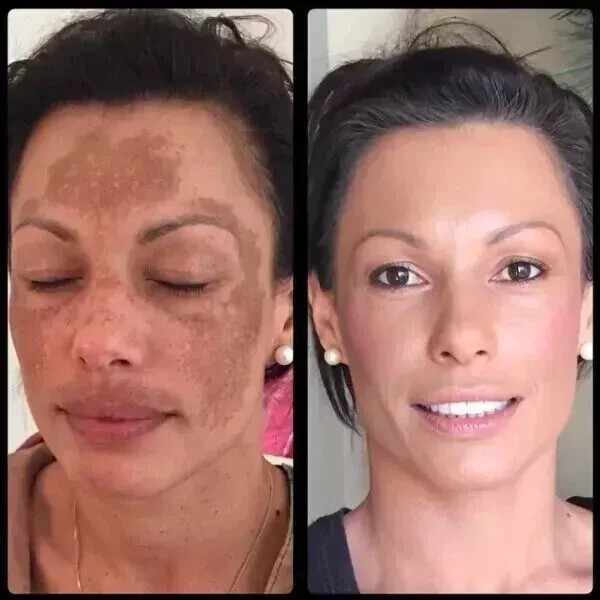 Wheezal Mel-X Melasma Cream (25g) for skin pigmentation like melasma, chloasma