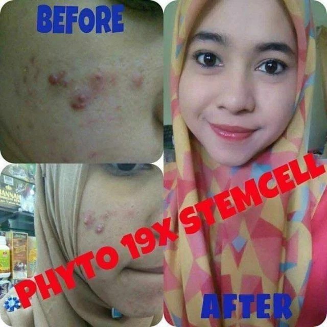 1x Phyto Collagen King of Whitening Anti-Aging 19X Stemcell FREE SHIPPING DHL