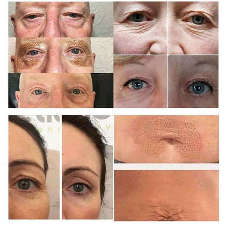 6Pcs/Set Replace Accessory for Mole Removal Plasma Pen Freckle Dark Spot Remover