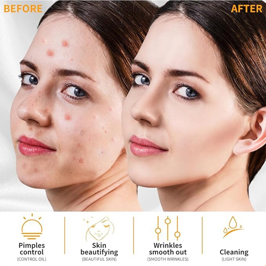 High Frequency Skin Therapy Wand 4PC Neon ARgon Facial Device Skin Care
