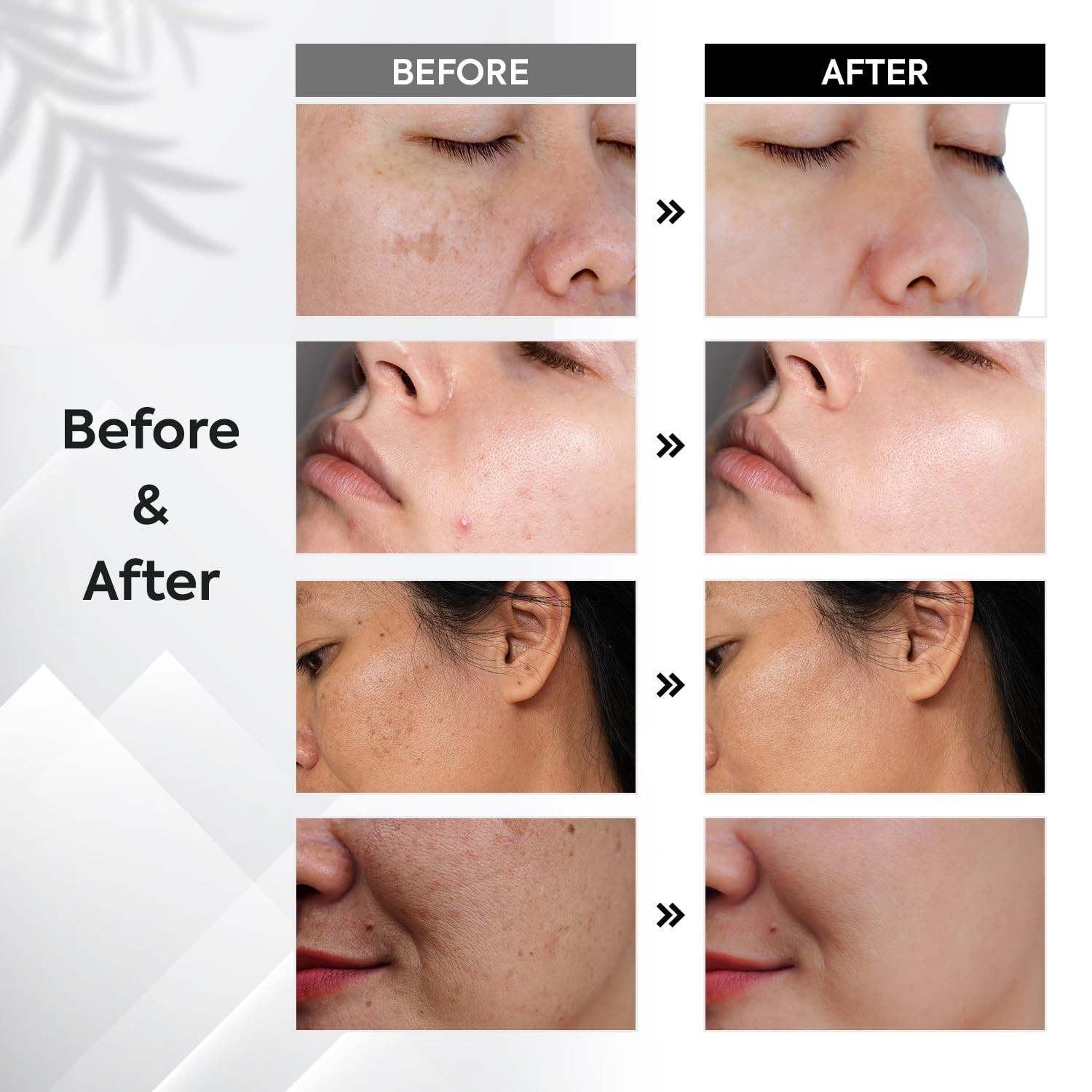 Dark Spot Remover for Face and Body Musely Dark Spot Remover for Melasma Sun ..
