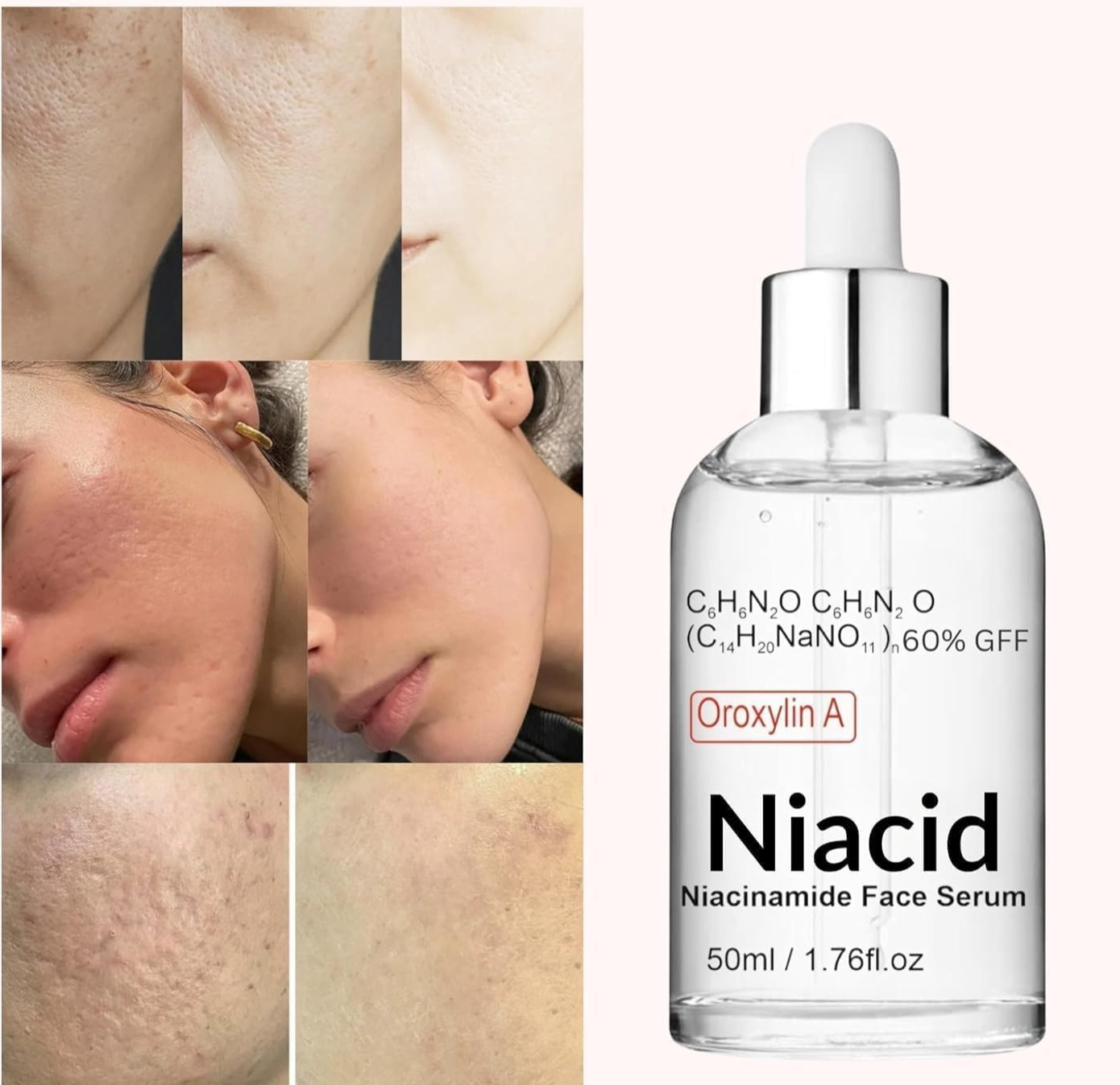 Niacid Niacinamide Face Serum 5% for remove Acne & Blemishes 50 ml