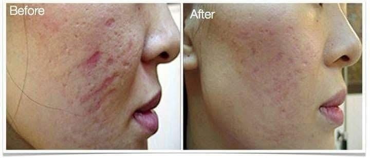 derma roller