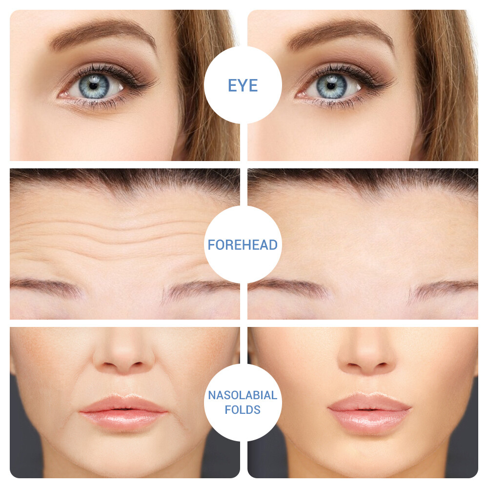 Hyaluronic Acid Micro-needle Eye Patch Anti-aging Wrinkle Fine Line Removal Mask