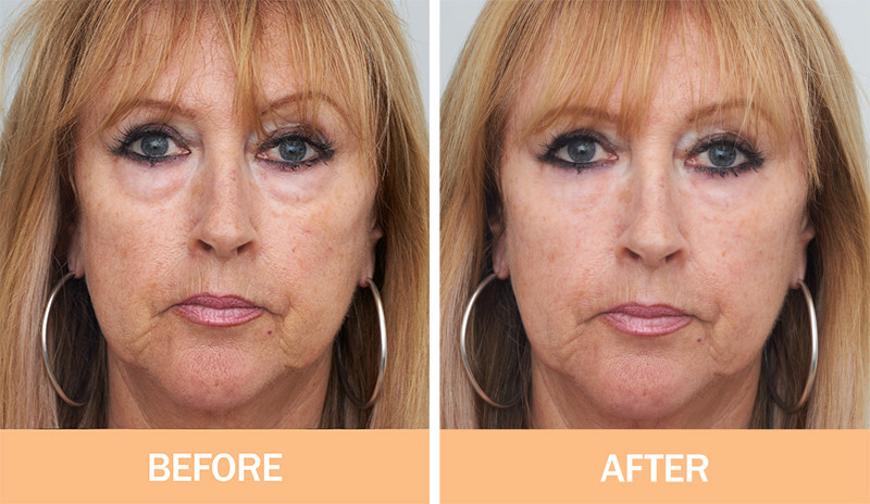 No.1 Instant Wrinkle Serum- LIFTING/ LINE ERASER/ 5 STAR REVIEWS- IT WORKS!
