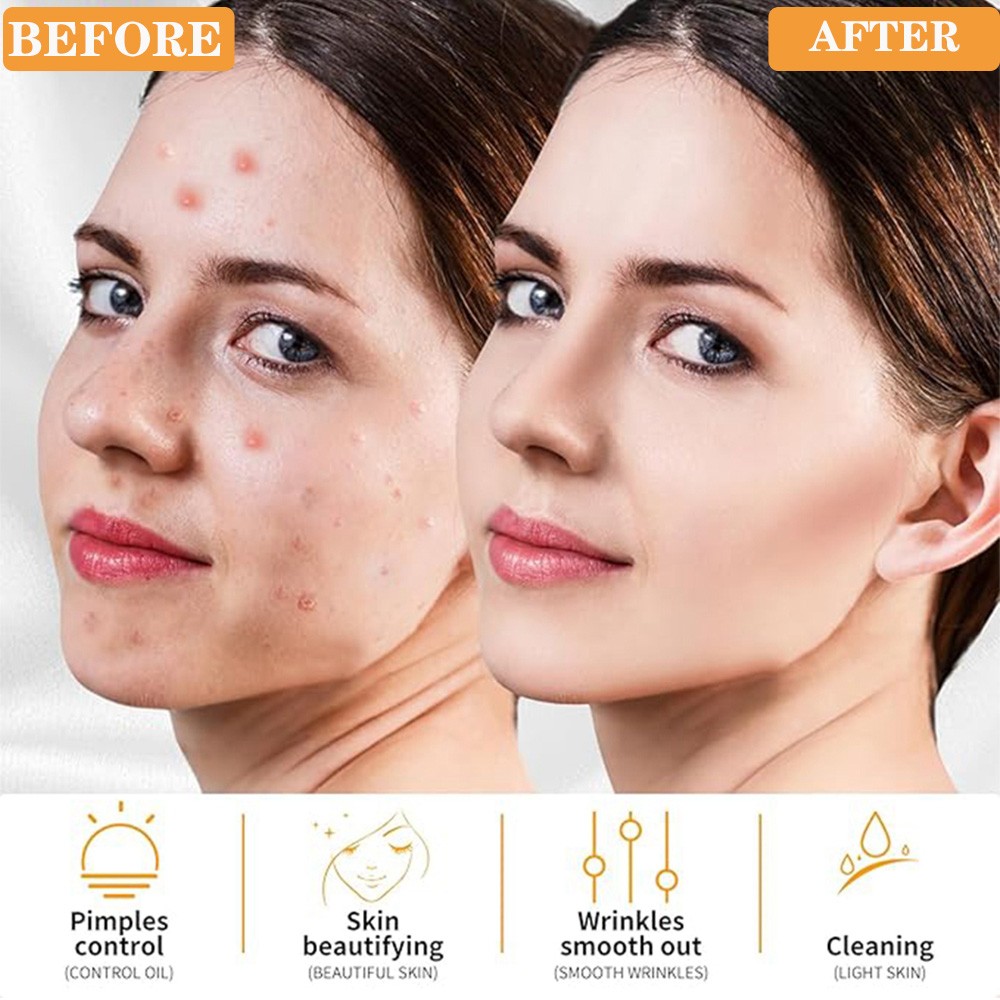 High Frequency Facial Machine 4 Wands Anti-Aging Acne Removal Skin Therapy