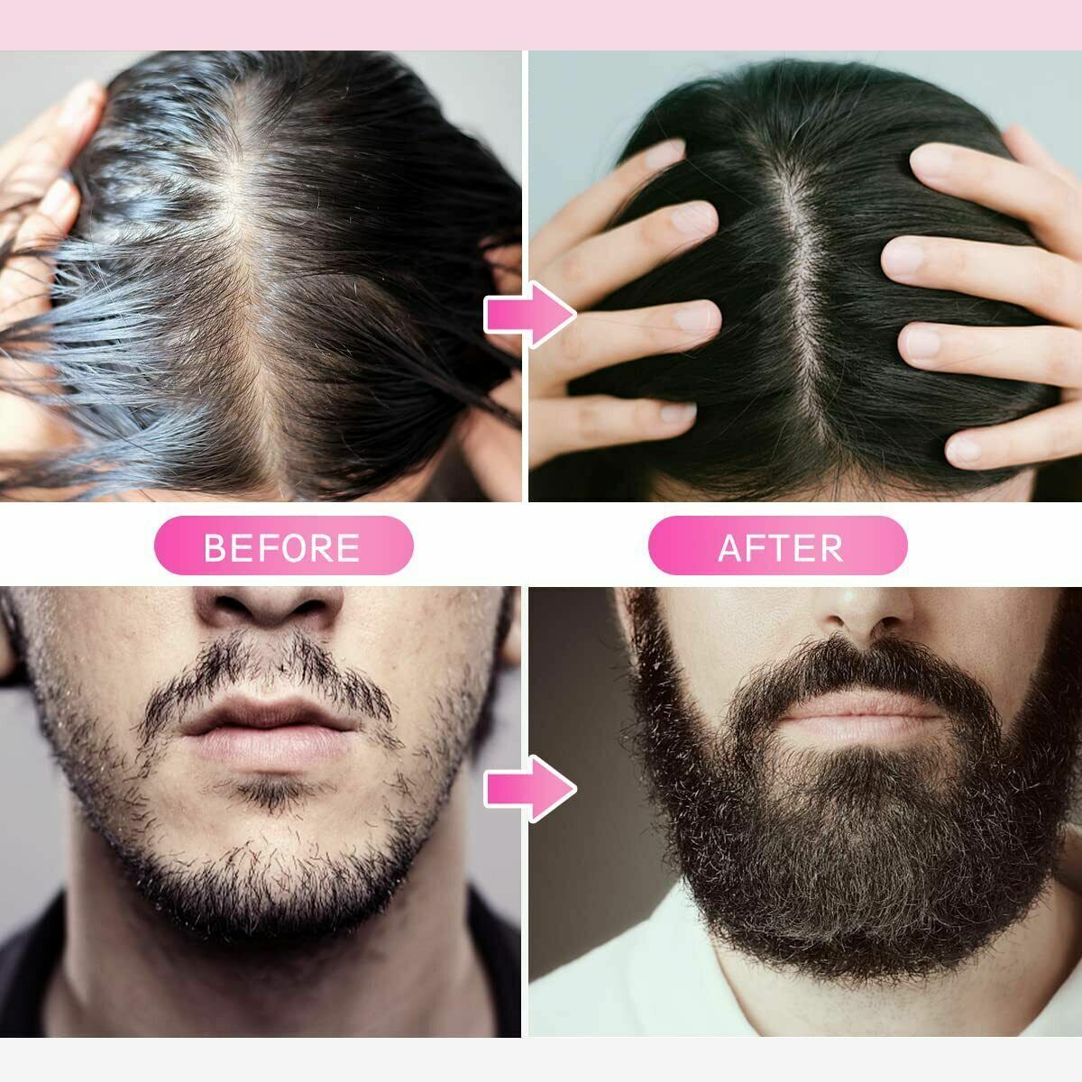 1.0mm Derma Roller Hair Regrowth Micro Needle Roller Beard Growth Anti Hair Loss