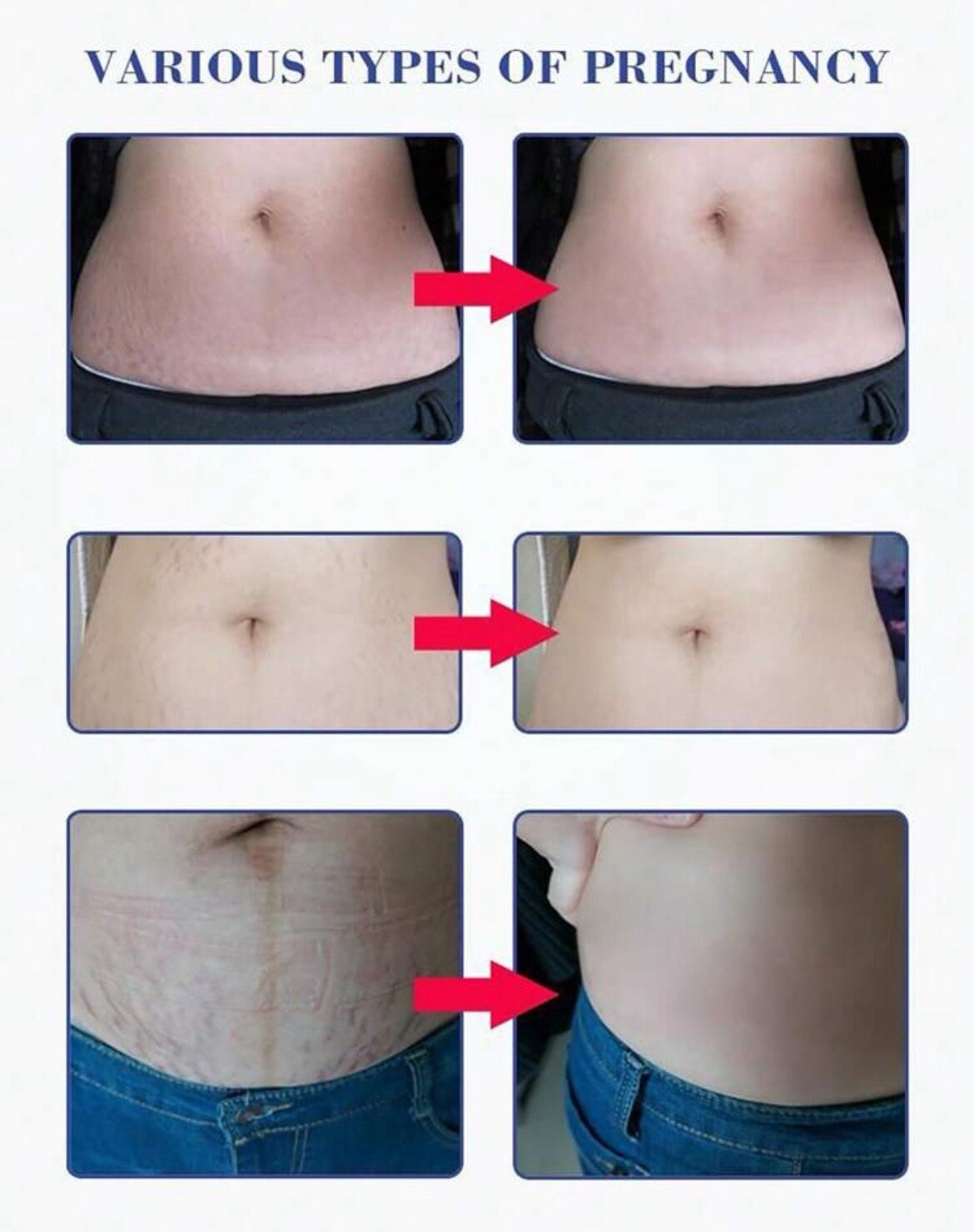 stretch marks Moisturize, Smooth, Firm, Repair