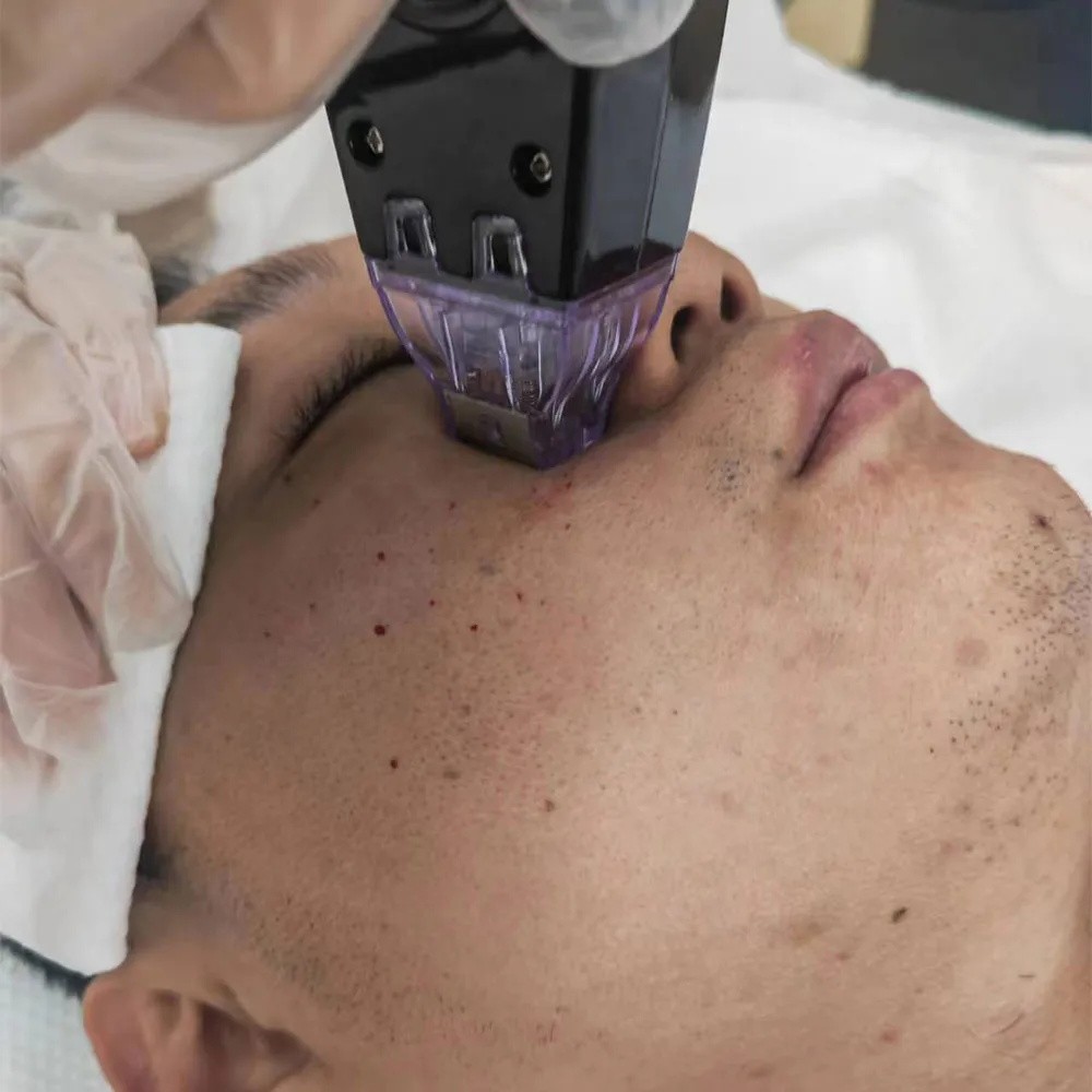 2025 Professional RF Beauty Spa Machine Face Lift With Cold Hammer Skin Care USA