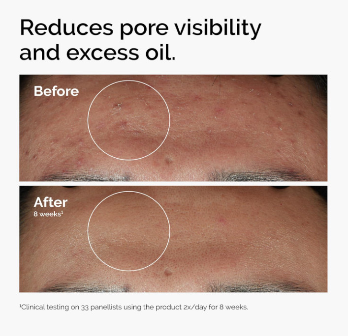 The Ordinary Niacinamide 10% + Zinc 1%, Smoothing Serum for Blemish-Prone Skin